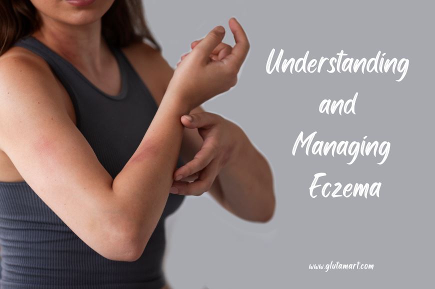Understanding and Managing Eczema